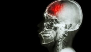 can alcohol cause a stroke
