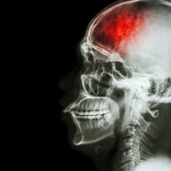 can alcohol cause a stroke